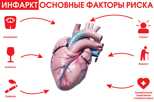 infarkt-2.jpg
